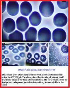 Live Blood Cell Analysis Post COVID Jab